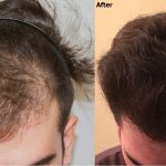 Reclaiming Your Confidence: Effective Hair Restoration Solutions for Men